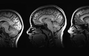 Three brain scans